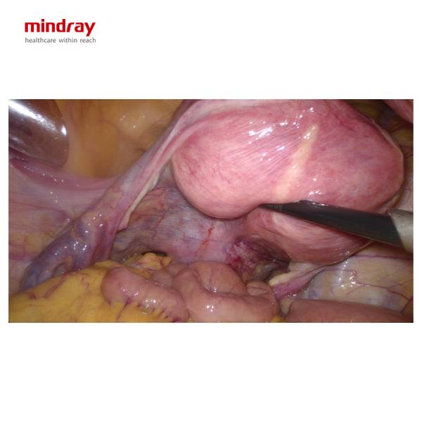 UX5 4K 3D WL Лапароскопічна стійка Mindray, рис. 4