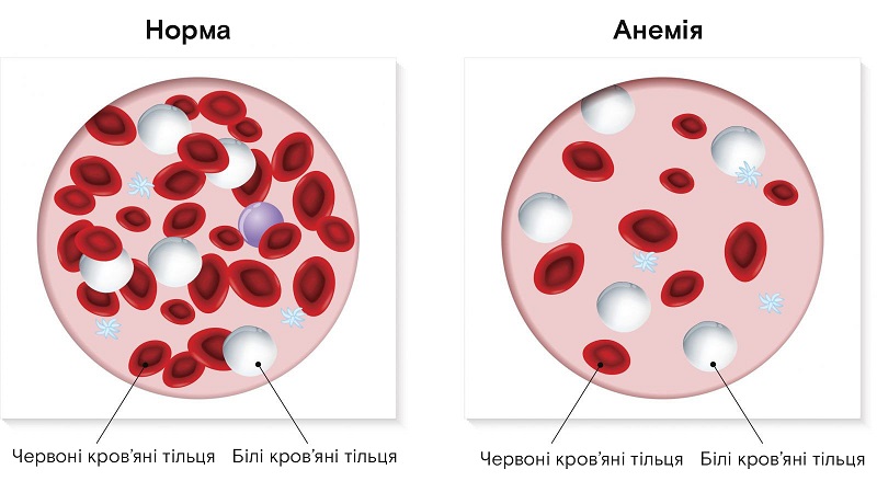 Симптомы анемии